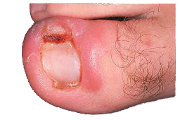 Minimal invasive nail surgery
